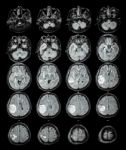 Mri Brain : Brain Tumor At Right Parietal Lobe Stock Photo