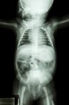 Film X-ray Whole Infant's Body Stock Photo