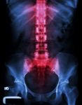 X-ray Lumbo-sacral Spine And Pelvis And Inflammation At Spine Stock Photo