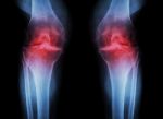 Osteoarthritis Knee ( Oa Knee ) ( Film X-ray Both Knee With Arthritis Of Knee Joint : Narrow Knee Joint Space ) ( Medical And Science Background ) Stock Photo