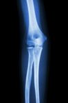 Film X-ray Elbow Ap : Show Normal Human's  Elbow Stock Photo