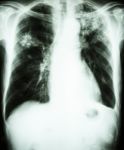 Pulmonary Tuberculosis Stock Photo