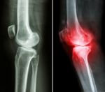 Normal Knee ( Left Image ) And Osteoarthritis Knee ( Right Image ) ( Lateral View ) Stock Photo