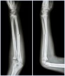 Fracture Shaft Of Ulnar Bone ( Forearm Bone )  :  ( Front And Side View ) Stock Photo