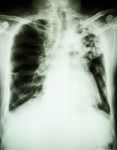 Pulmonary Tuberculosis Stock Photo