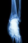 Film X-ray Ankle Show Fracture Distal Tibia And Fibula (leg's Bone) Stock Photo