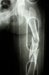 Fracture Shaft Of Femur Stock Photo