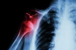 X-ray Anterior Shoulder Dislocation Stock Photo