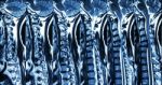 Cervical Spondylosis With Disc Herniation ( Mri Of Cervical Spine : Show Cervical Spondylosis With Disc Herniation Compress Spinal Cord ( Myelopathy ) ) Stock Photo