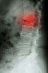 Film X-ray Lumbar Spine Lateral : Show Burst Fracture At Lumbar Stock Photo