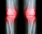 Osteoarthritis Both Knee .  Film X-ray Ap ( Anterior - Posterior ) Of Knee Show Narrow Joint Space , Osteophyte ( Spur ) , Subcondral Sclerosis Stock Photo