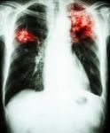 Pulmonary Tuberculosis Stock Photo