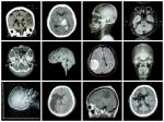 Collection Of Brain Disease ( Ct Scan And Mri Of Brain : Show Cerebral Infarct , Intracerebral Hemorrhage , Brain Tumor , Basal Ganglia Hemorrhage ( Status Post Craniotomy ) ) ( Health Care Concept ) Stock Photo