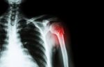 Fracture At Neck Of Humerus ( Arm Bone ) ( Film X-ray Left Shoulder And Blank Area At Right Side ) Stock Photo