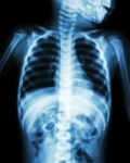 Chest X-ray Of Child Show Neck , Thorax , Shoulder , Arm , Abdomen Stock Photo