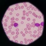 Blast Cells In Peripheral Blood Images Stock Photo