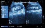 Ultrasonography Of Kidney : Show Left Kidney Stone ( 2 Image For Compare ) Stock Photo