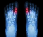 "rheumatoid Arthritis , Gouty Arthritis"  X-ray Child's Foots And Arthritis At Metatarsophalangeal Joint (big Toe Area) Stock Photo