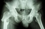 Fracture Right Femur (thigh's Bone) Stock Photo