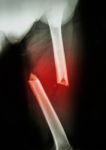 Fracture Femur Stock Photo