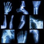 Collection Of Bone Fracture Stock Photo