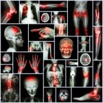 Collection X-ray Part Of Human,orthopedic Operation,multiple Disease (fracture,gout,rheumatoid Arthritis,osteoarthritis Knee,stroke,brain Tumor,scoliosis,tuberculosis, Etc.) Stock Photo