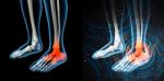 3d Render Human Foot Pain With The Anatomy Of A Skeleton Foot Stock Photo