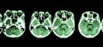 Ct Scan Of Brain And Base Of Skull ( Show Structure Of Eye , Ethmoid Sinus , Cerebellum , Cerebrum, Etc ) Stock Photo