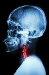 X-ray Asian Skull And Cervical Spine And Neck Pain Stock Photo