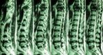 Mri Of Lumbar & Thoracic Spine : Show Fracture Of Thoracic Spine And Compress Spinal Cord ( Myelopathy ) Stock Photo