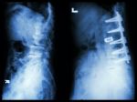 "spondylosis" (left Image) , Patient Was Operated And Internal Fixed. (right Image) In Old Man Stock Photo