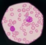 Blast Cells In Peripheral Blood Images Stock Photo