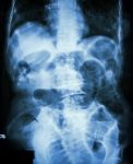 Small Bowel Obstruction.  Film X-ray Abdomen Supine :  Show Small Bowel Dilated Due To Small Bowel Obstruction Stock Photo