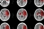 Ischemic Stroke : ( Ct Of Brain Show Cerebral Infarction At Left Frontal - Temporal - Parietal Lobe ) ( Nervous System Background ) Stock Photo