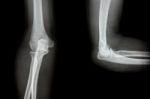 Film X-ray Elbow Ap(antero-posterior)/lateral Stock Photo