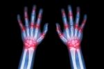 Rheumatoid Arthritis , Gout Arthritis  ( Film X-ray Both Hands Of Child With Multiple Joint Arthritis ) ( Medical , Science And Health Care Concept ) Stock Photo