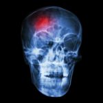 " Stroke (cerebrovascular Accident) "  X-ray Side Of Asian Skull Stock Photo