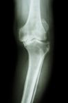 Osteoarthritis Knee Patient Stock Photo