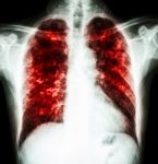 Pulmonary Tuberculosis Stock Photo