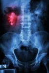 Right Renal Calculi (staghorn) Stock Photo