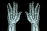 Fracture Shaft Of Proximal Phalange Of Ring Finger ( Film X-ray Both Hand Ap ) Stock Photo