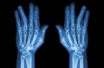 Fracture Shaft Of Proximal Phalange Of Ring Finger ( Film X-ray Both Hand Ap ) Stock Photo