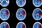 Ischemic Stroke : ( Ct Of Brain Show Cerebral Infarction At Left Frontal - Temporal - Parietal Lobe ) ( Nervous System Background ) Stock Photo