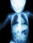 Film X-ray Child 's Body ( Normal Baby ) Stock Photo