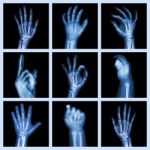 Collection X-ray Of Hands Stock Photo