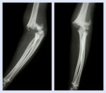 Fracture Elbow (left Image : Side Position , Right Image : Front Position) Stock Photo