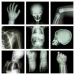 Collection X-ray Part Of Child Body Stock Photo