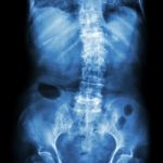 Spondylosis And Scoliosis ( Film X-ray Lumbar - Sacrum Spine Show Crooked Spine ) ( Old Patient ) ( Spine Healthcare ) Stock Photo