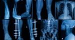 Collection Of  X-ray , Multiple Part Of Adult  Show Fracture Bone And  Disease Stock Photo