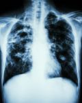 Mycobacterium Tuberculosis Infection (pulmonary Tuberculosis) Stock Photo